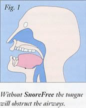 Figure 1 - Without Snorefree, the tongue will obstruct the airways